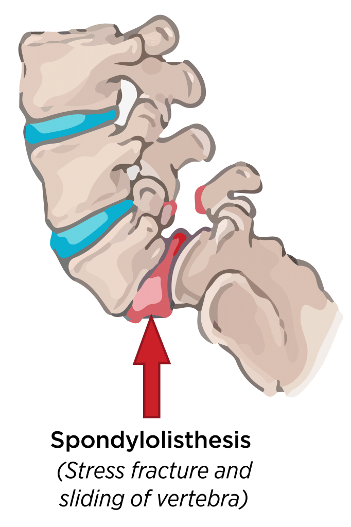 stress fracture in the vertebra that leads to spondylolisthesis
