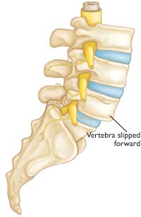Spondylolisthesis from a slipped vertebra in your back