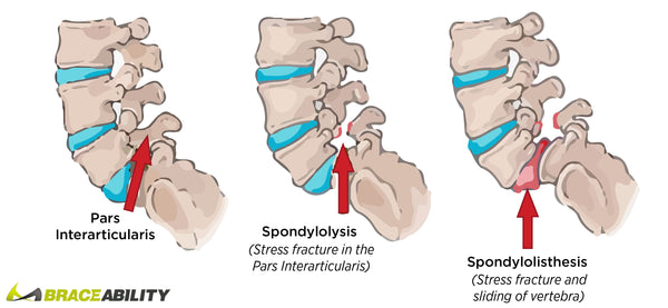 how to tell the difference between spondylolysis and spondylolisthesis when vertebra slides