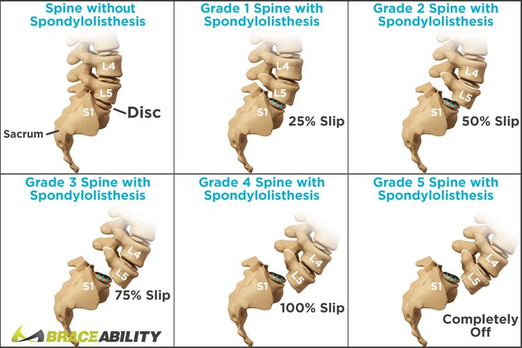 chart showing the different stages of spondylolisthesis and when you should have surgery