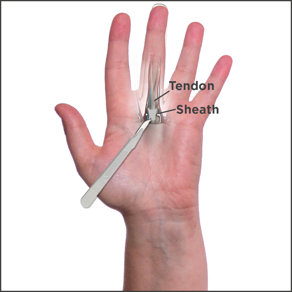 Trigger finger surgery anatomy and where a surgeon will make a small incision