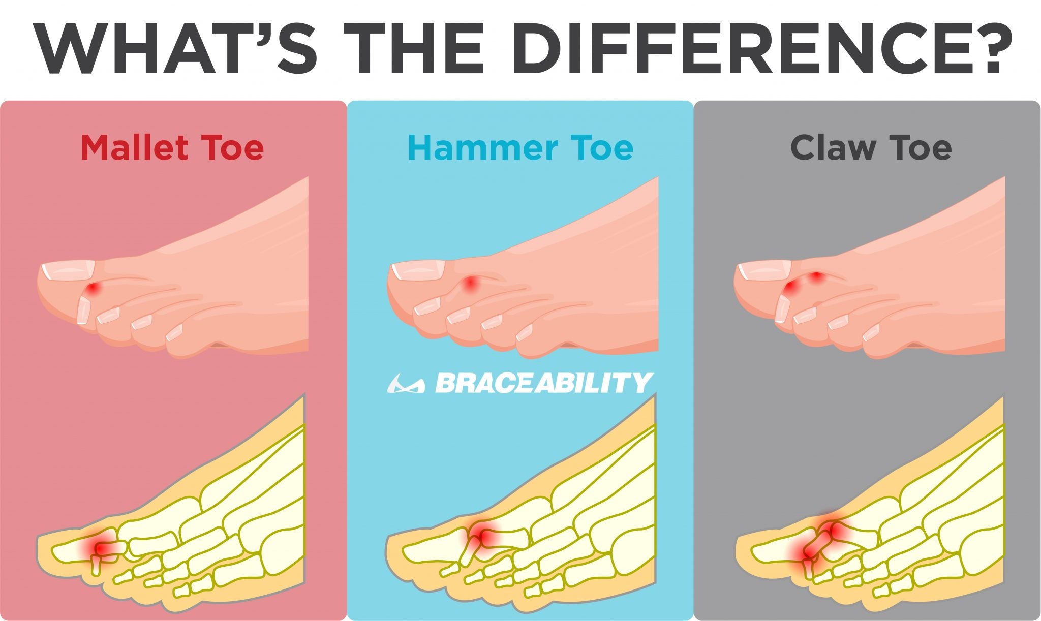  a diferença entre o dedo do pé de martelo, o de martelo e o de garra é o que está lesionado na articulação do dedo do pé
