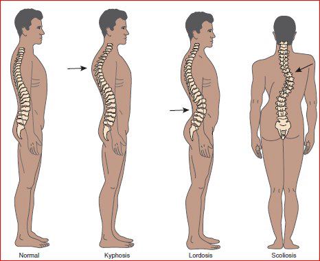 back pain from abnormal spine curves such as scoliosis, kyphosis, lordosis