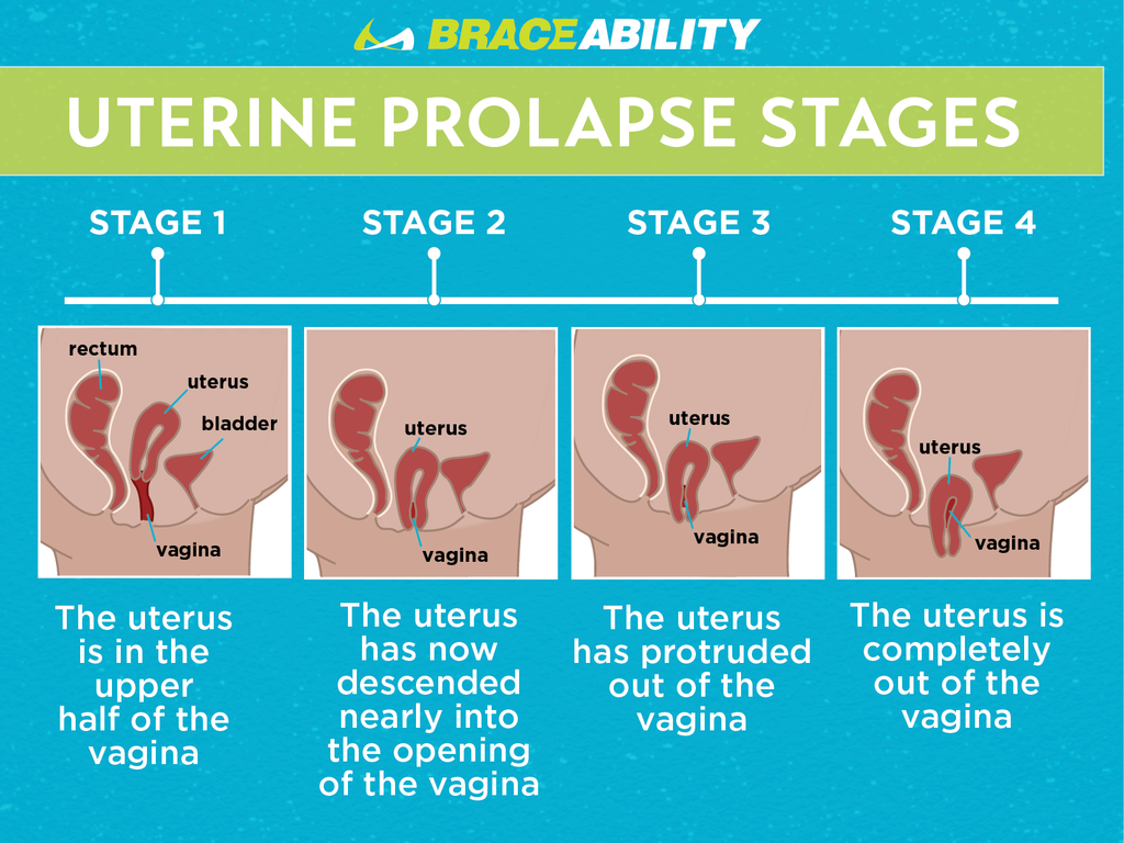 uterine prolapse stages