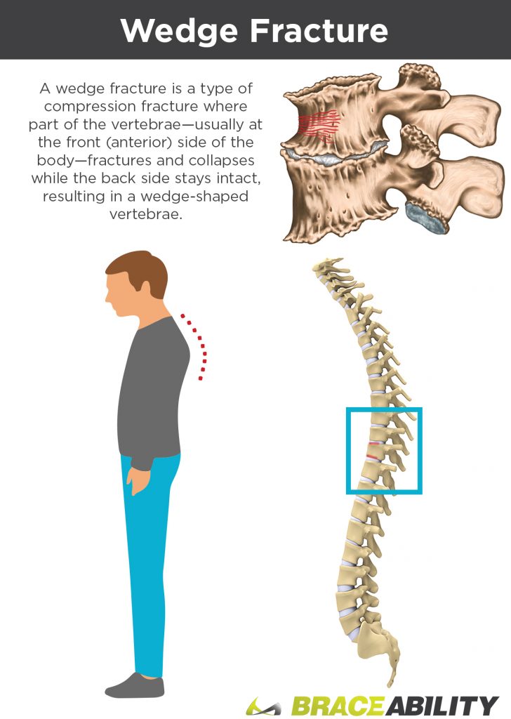 wedge fracture in spine compresses disc and curves your back