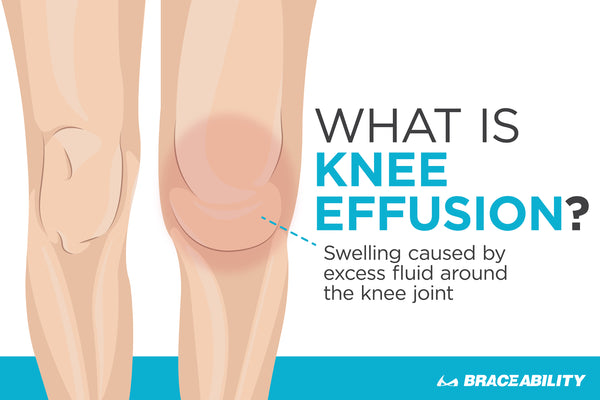 Learn about knee effusion fluid on the knee, causes, and treatment