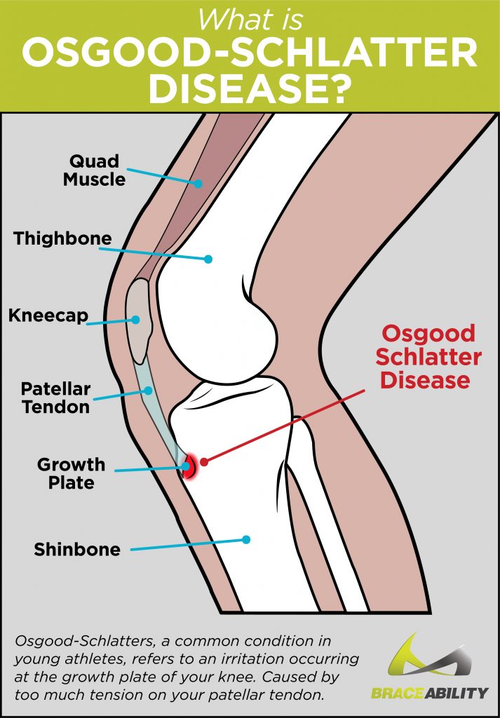 Infographic explaining what Osgood Schlatter disease is and where it's at with labeled anatomy