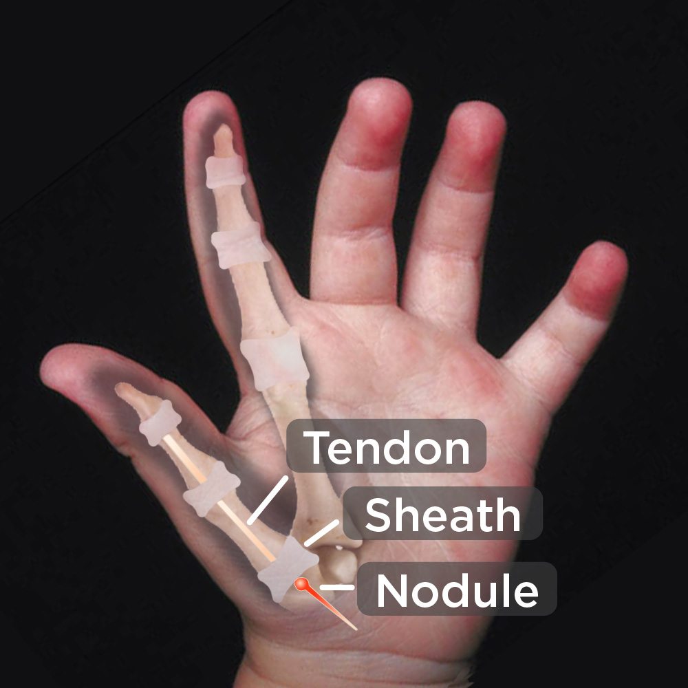 anatomy of a childs hand with trigger thumb
