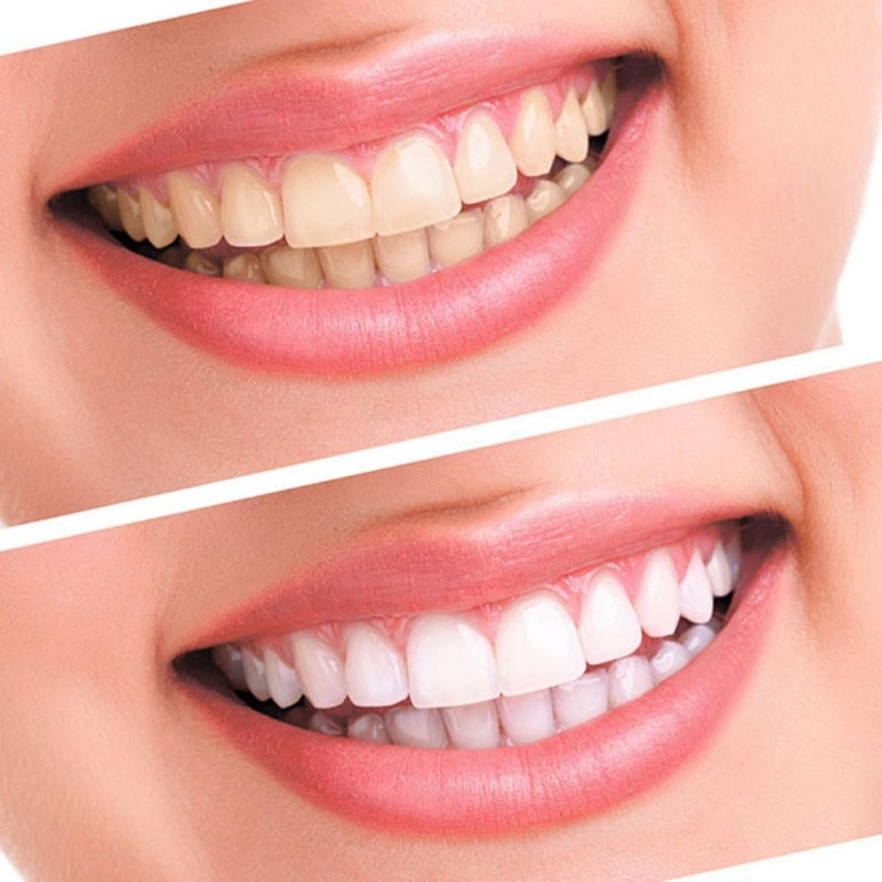 Teeth Whitening 44% Peroxide Dental Gel Kit