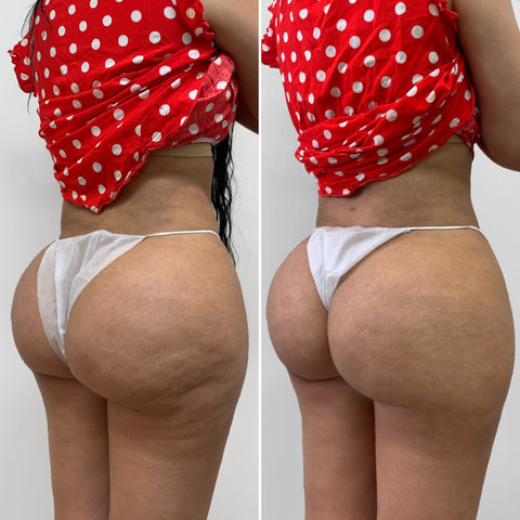 BootyFix: Renuva Butt Lift