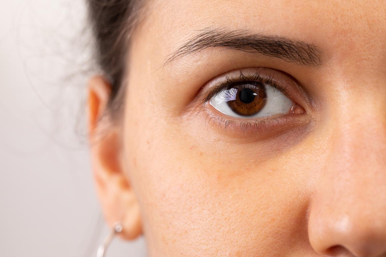 Bags under eyes benefit from green tea and turmeric and may not need laser resurfacing