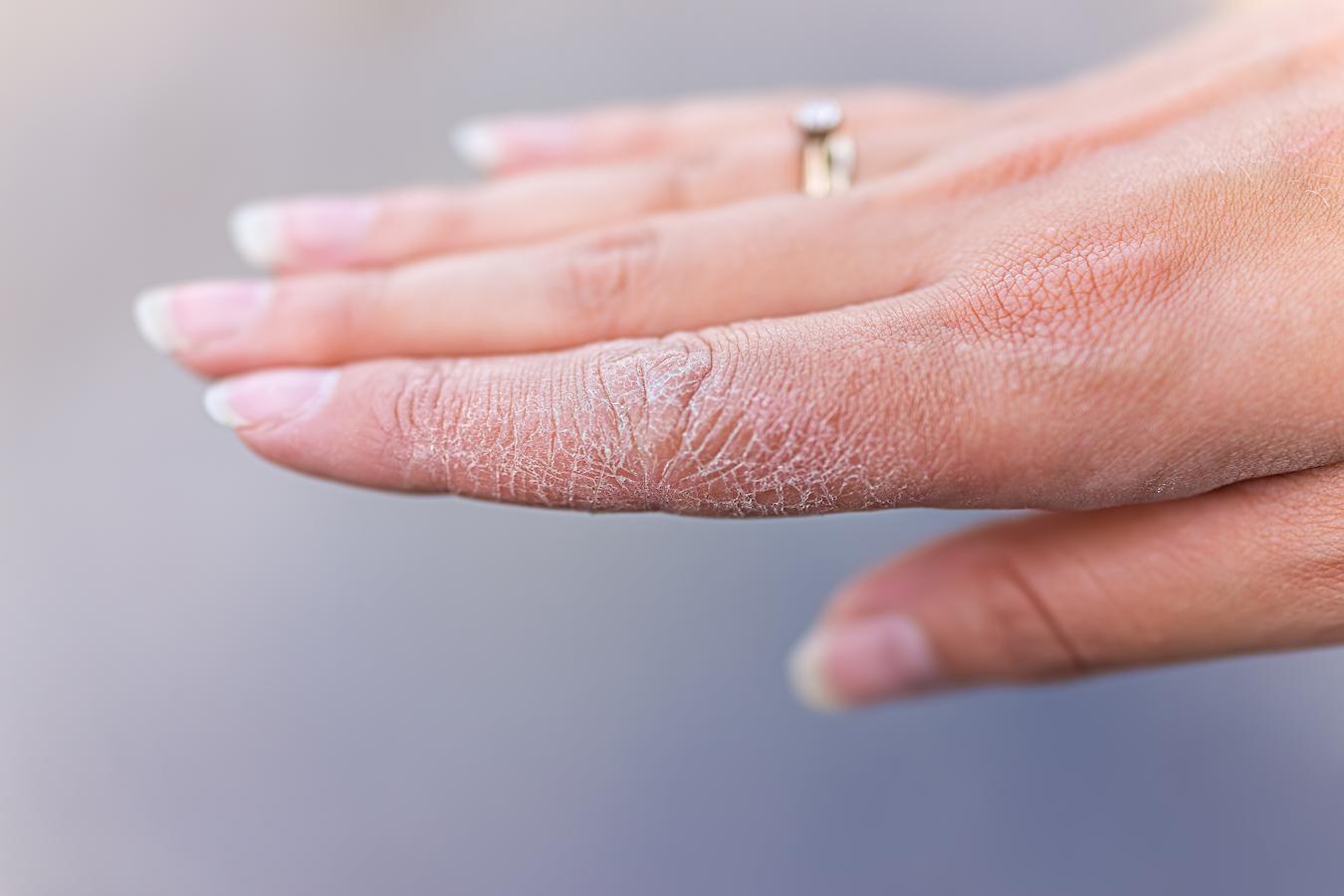 dry hands appearance of wrinkles reduce wrinkles skin texture skin cancer anti wrinkle creams