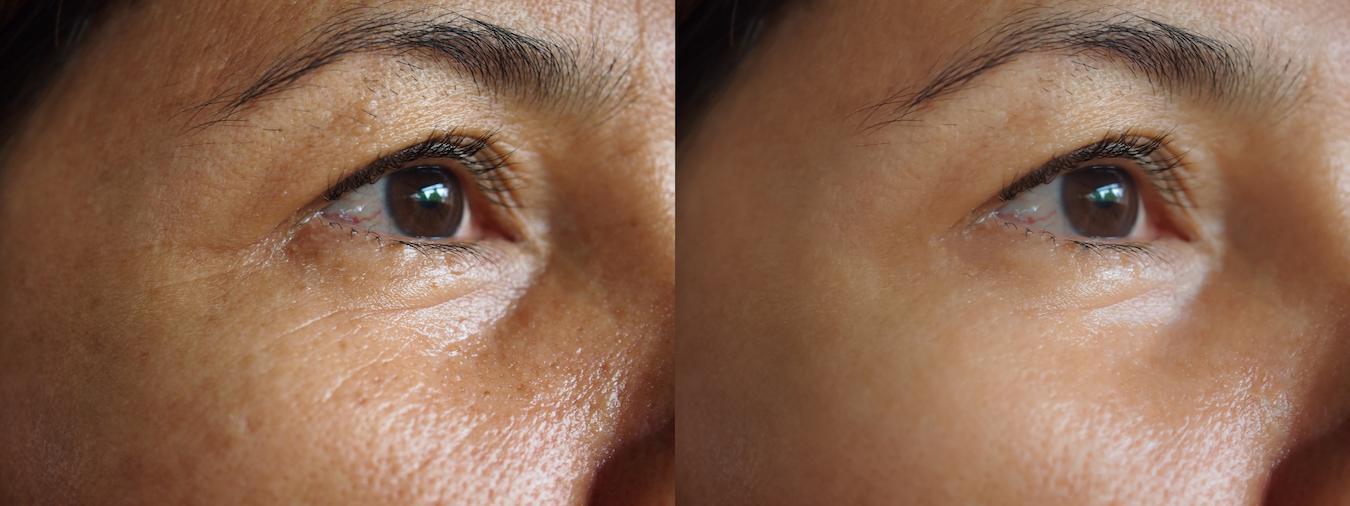 What Causes Dermatochalasis baggy eyes  The Eyelid Institute