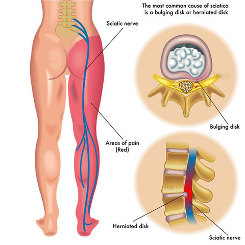 Traditional treatments for sciatica