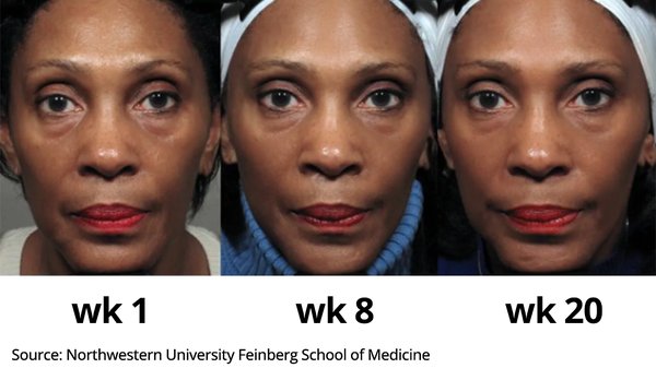 Images of woman's face at week 1, week 8, and week 20 of clinical trial