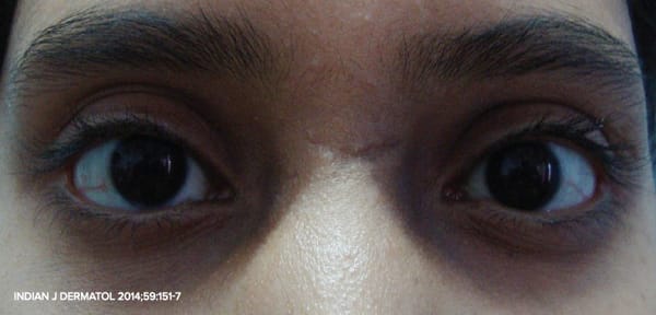 Close-up of eyes with pigmented dark circles