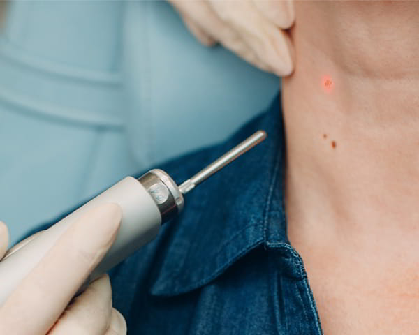 A laser device points at a brown spot on a patient's neck 