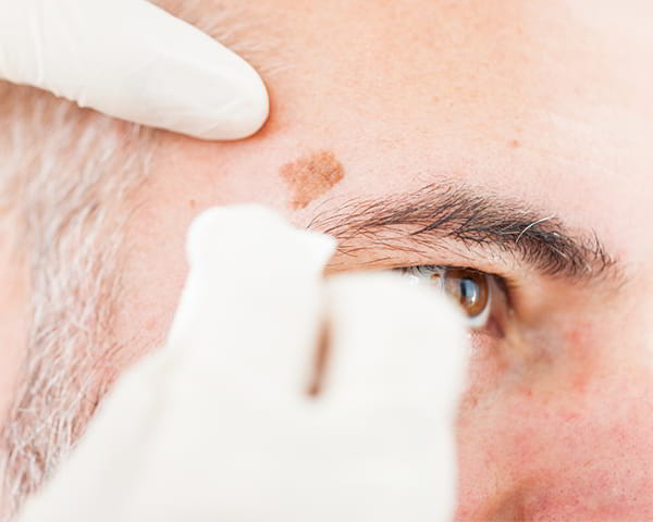 Hands in white gloves examine a dark area on a middle-aged man's face