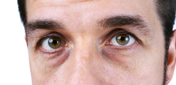 Close-up of eyes with anatomical-structural dark circles under the eyes