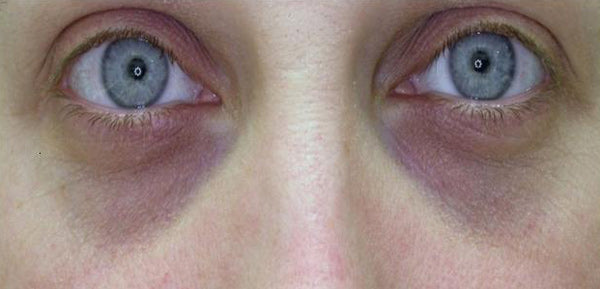 Close-up of eyes with vascular-type, blueish-purple under eye circles