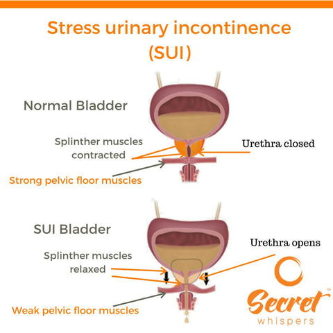 Stress urinary incontinence diagram