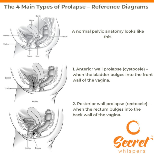 diagrams of prolapses