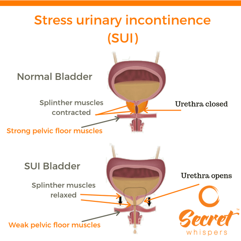 stress incontinence image diagram