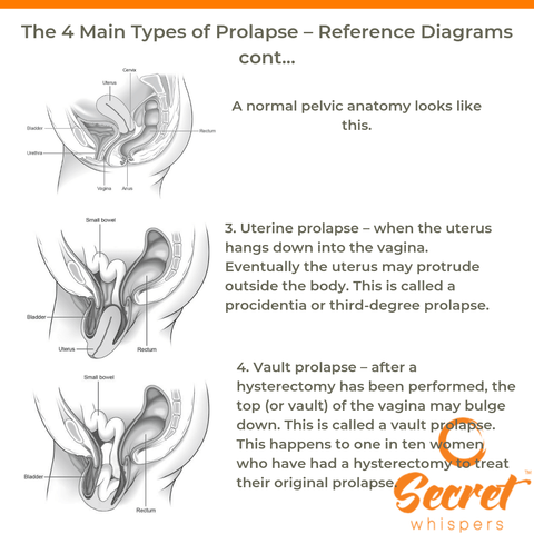 what does a uterine and vault prolapse look like?