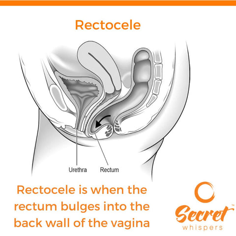 what does a rectocele look like