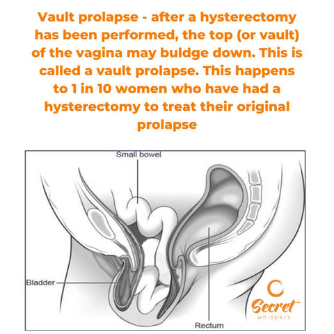 what does a vault prolapse look like?