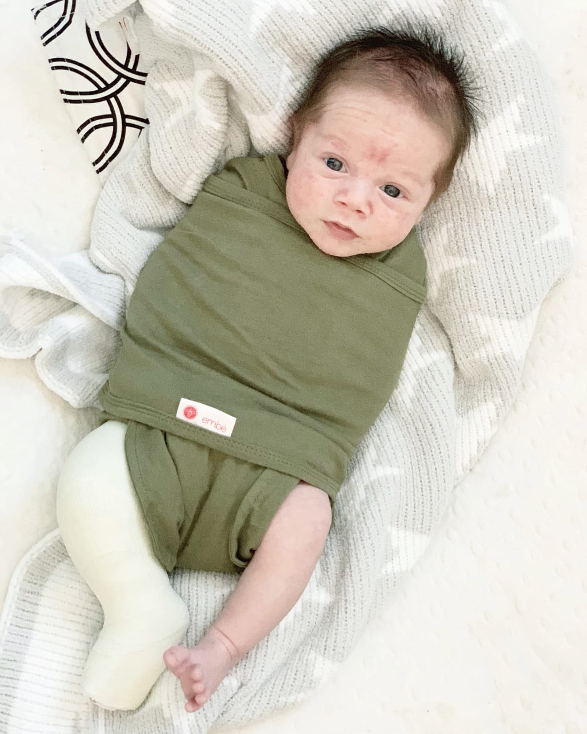 How To Swaddle Your Clubfoot Baby With Casting Or Boots And Bar Phase Embe