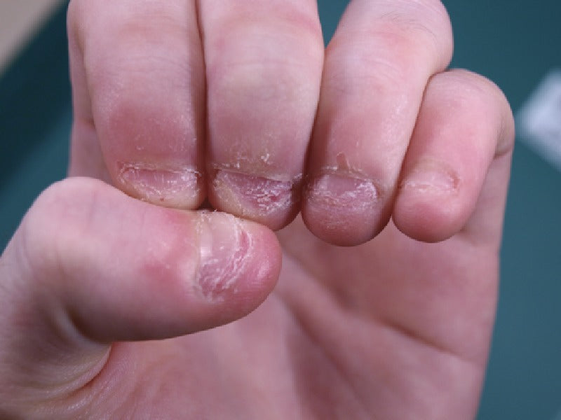 Cureus | Skin Biter: Dermatodaxia Revisited | Article