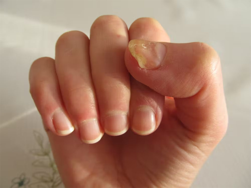 Causes Of Fungal Nail Infection And Preventive Tips - Amar Ujala Hindi News  Live - Nails Fungus:ध्यान से देखें अपने नाखूनों का रंग, पसीना दे रहा ये  बीमारी; जानें क्या कहते हैं