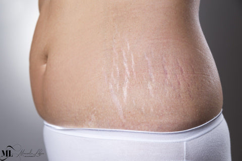 Skin Treatments that Remove Stretch Marks