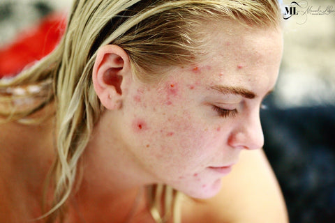Ways to Effectively Get Rid of Acne Scars