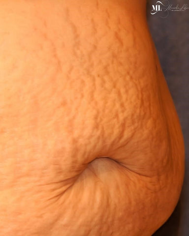 Stretch marks Atrophied abdomen | Stretch Mark Cream for Abdomen