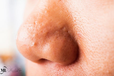 Nose with large pores and acne - ML Delicate Beauty