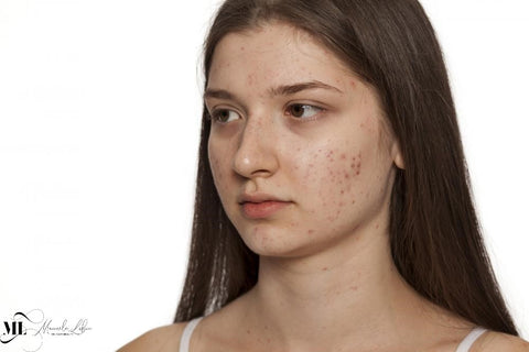 Girl with acne all over her face - ML Delicate Beauty