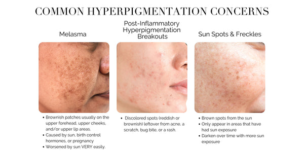 How to get rid of hyperpigmentation