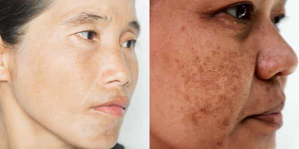 what does melasma look like