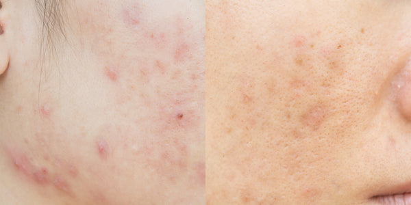 what does post-inflammatory hyperpigmentation look like