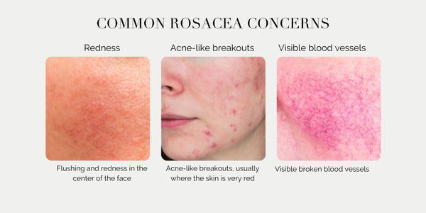 what does rosacea look like