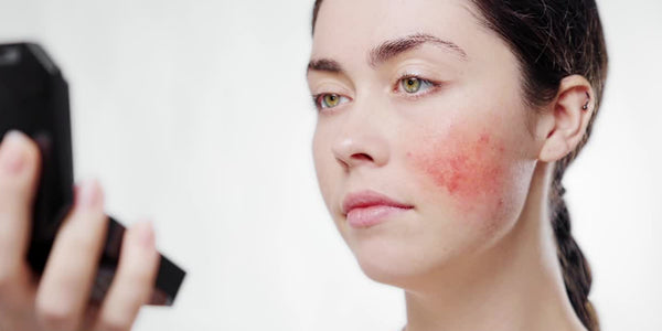 what is rosacea