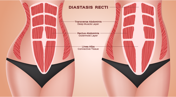 Illustrating a woman's abdominal muscles, highlighting the condition of diastasis recti