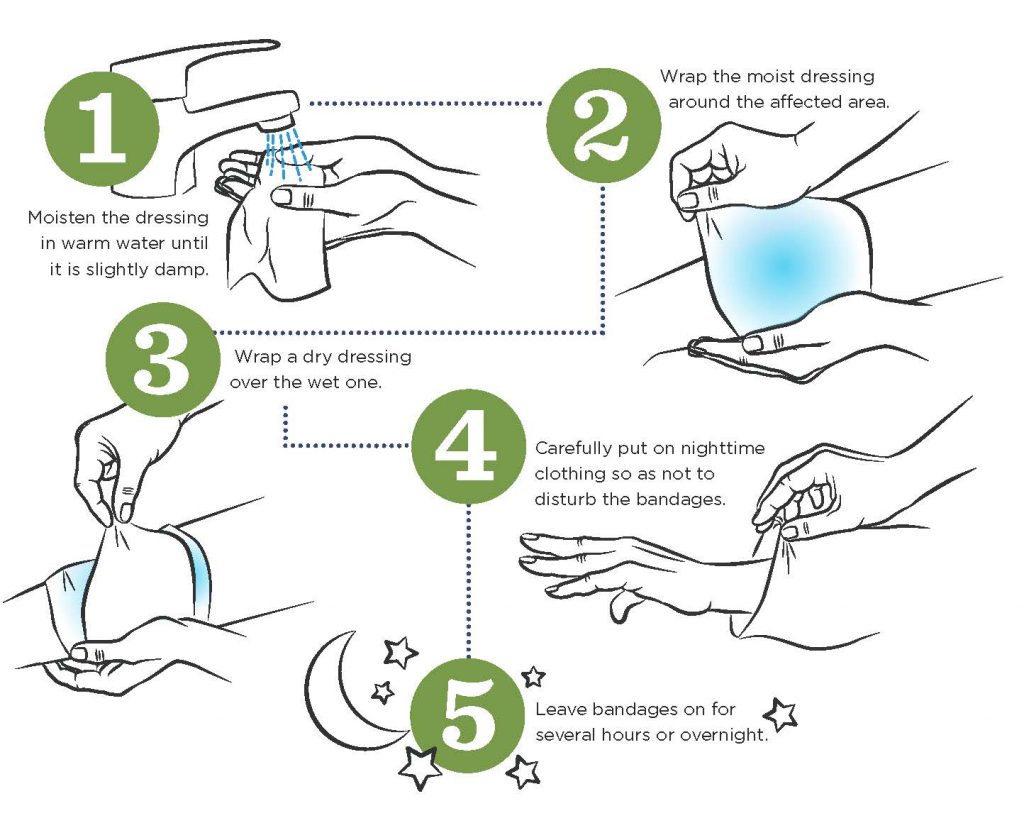 wet wrap therapy steps by NEA