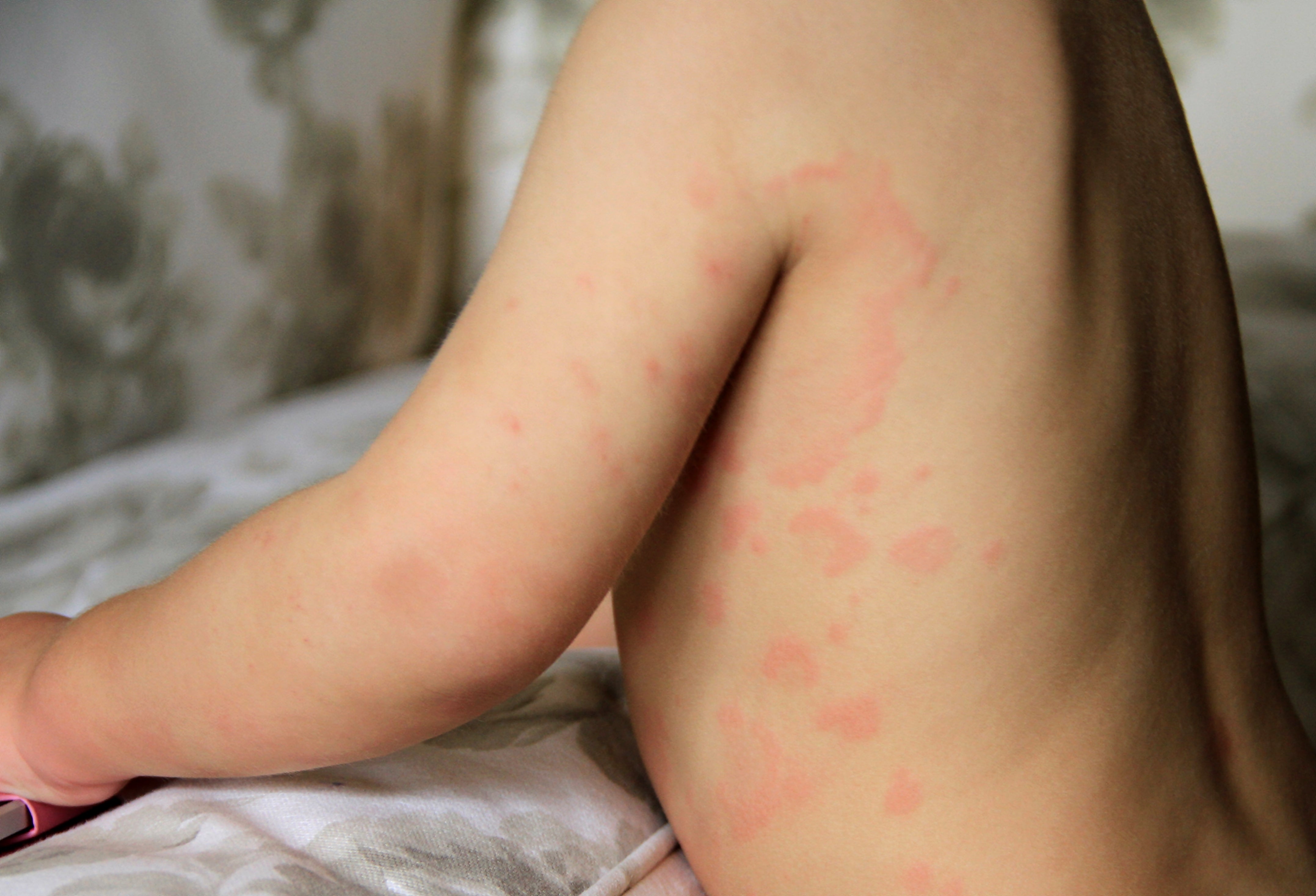 kids in eczema often develop red rashes and itchy irritationaround several parts of their body