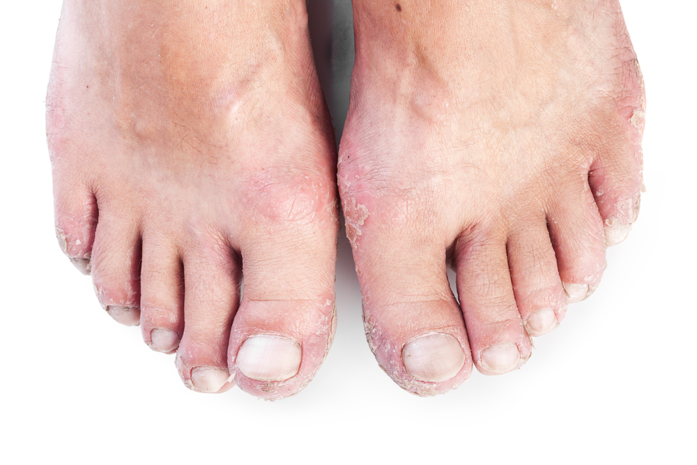 eczema on feet
