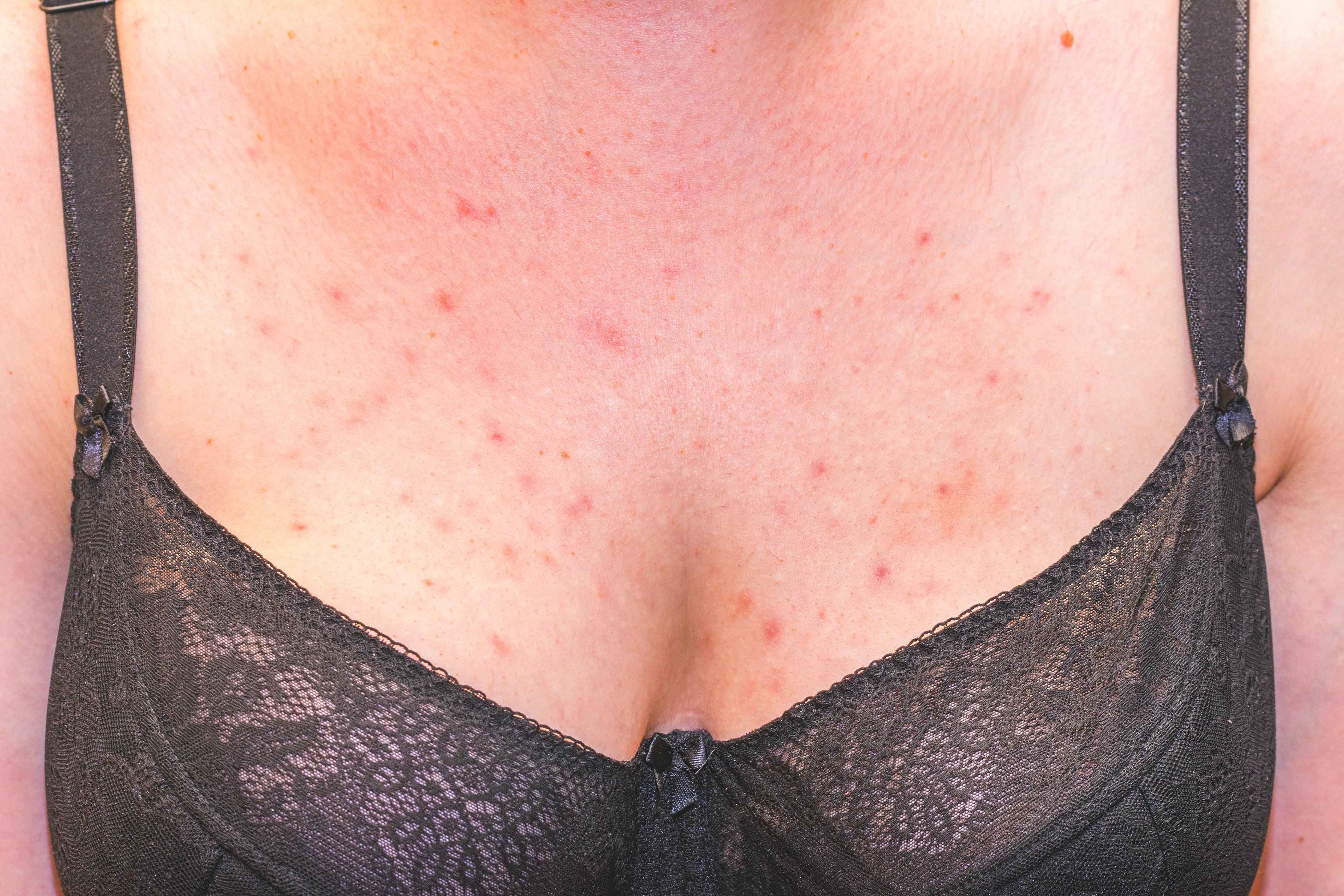 4 Common Skin Reactions Brought by Wearing the Wrong Bras – Cottonique -  Allergy-free Apparel