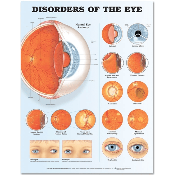 Anatomical Chart Company Anatomical Charts Disorders of the Eye Anatomical Chart