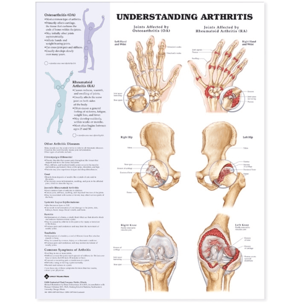Anatomical Chart Company Anatomical Charts Understanding Arthritis Anatomical Chart